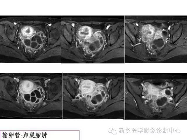 【PPT】卵巢的解剖和疾病诊断思路