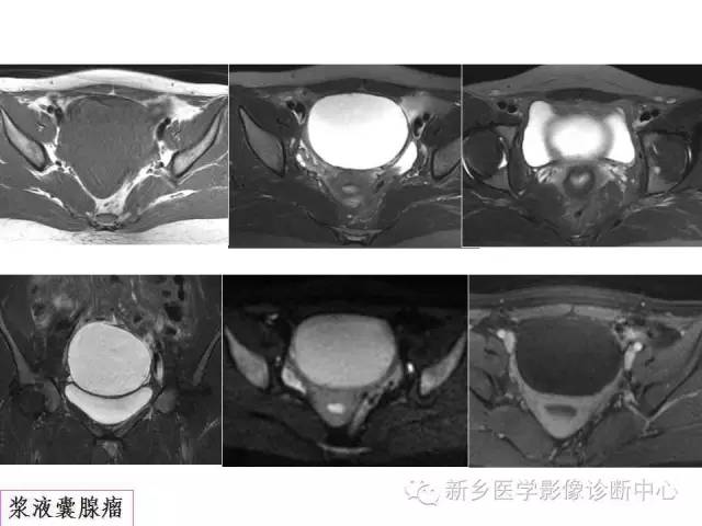 【PPT】卵巢的解剖和疾病诊断思路