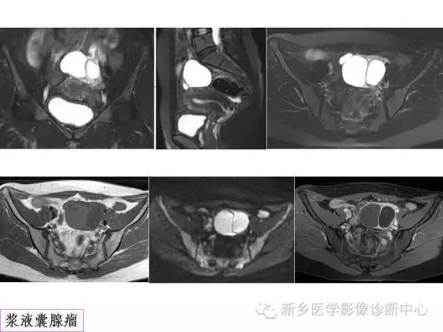 【PPT】卵巢的解剖和疾病诊断思路