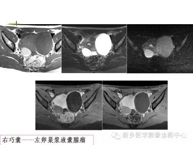 【PPT】卵巢的解剖和疾病诊断思路