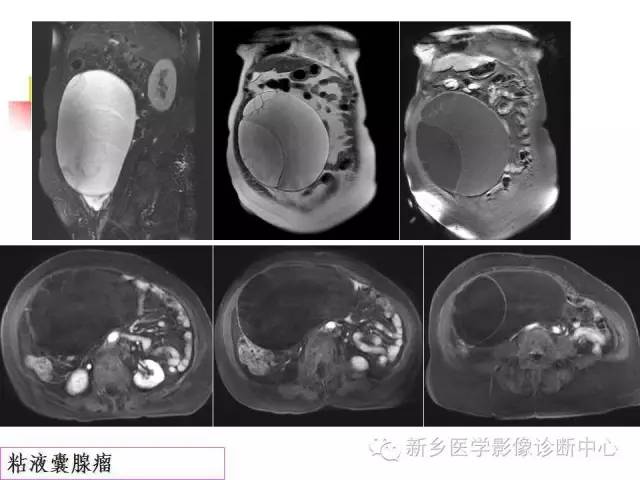 【PPT】卵巢的解剖和疾病诊断思路