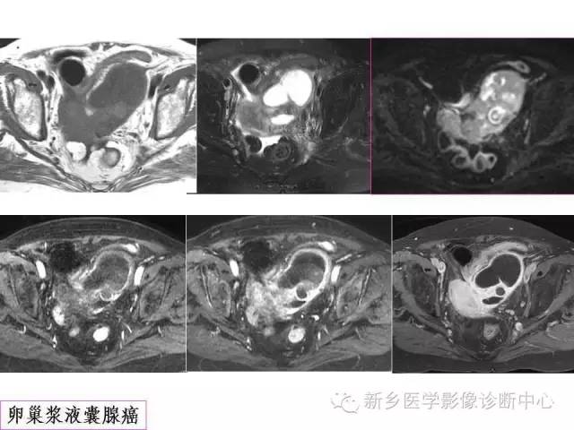 【PPT】卵巢的解剖和疾病诊断思路
