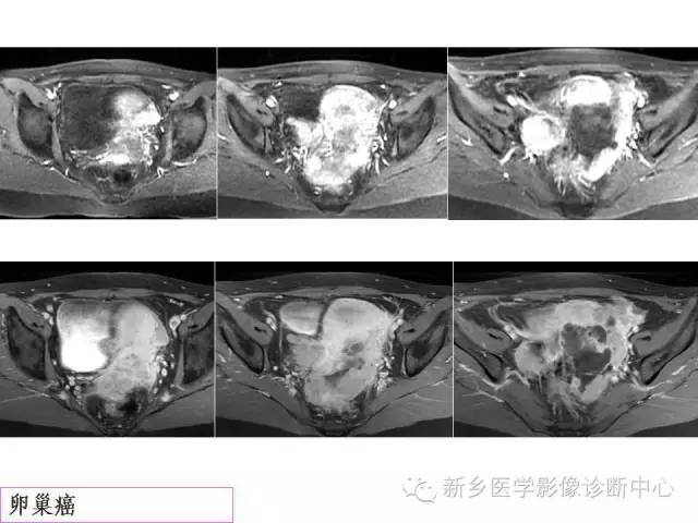 【PPT】卵巢的解剖和疾病诊断思路