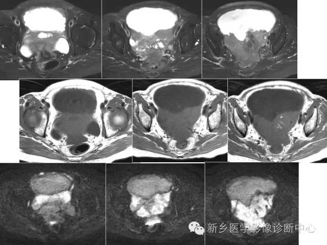 【PPT】卵巢的解剖和疾病诊断思路