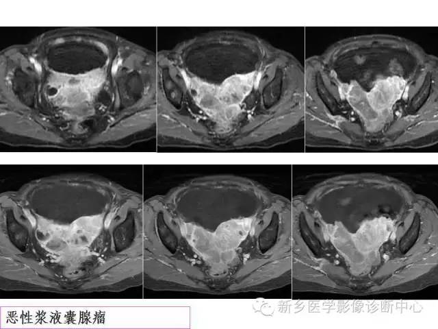 【PPT】卵巢的解剖和疾病诊断思路