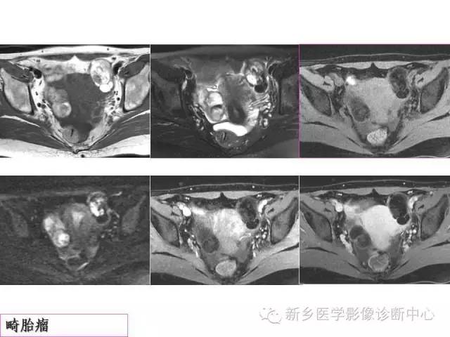 【PPT】卵巢的解剖和疾病诊断思路
