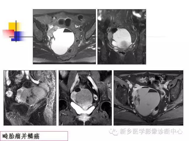【PPT】卵巢的解剖和疾病诊断思路