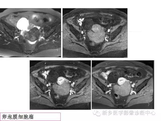 【PPT】卵巢的解剖和疾病诊断思路