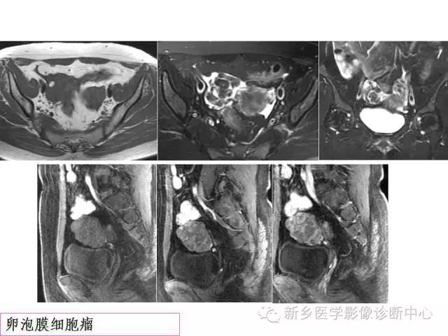 【PPT】卵巢的解剖和疾病诊断思路