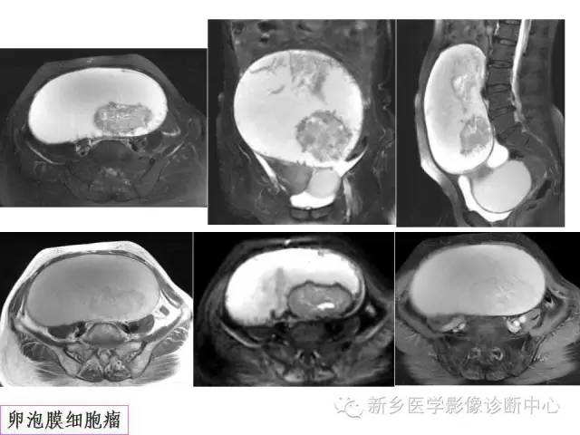 【PPT】卵巢的解剖和疾病诊断思路