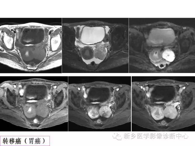 【PPT】卵巢的解剖和疾病诊断思路