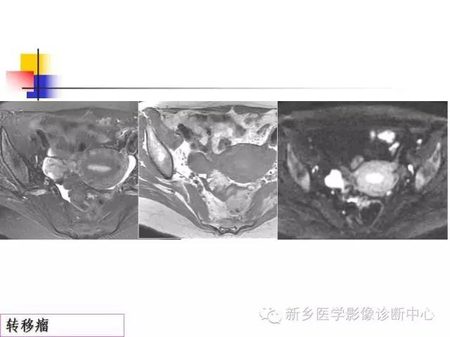 【PPT】卵巢的解剖和疾病诊断思路