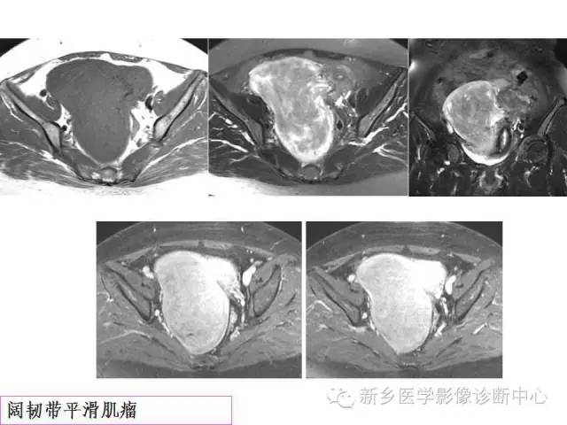 【PPT】卵巢的解剖和疾病诊断思路