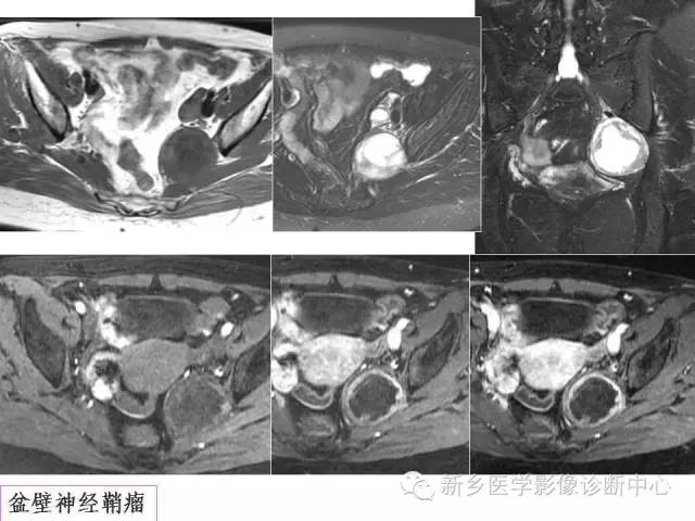 【PPT】卵巢的解剖和疾病诊断思路