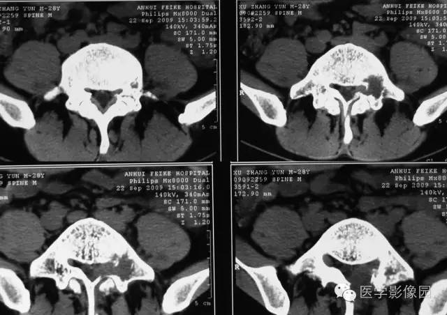 【病例】椎板骨嗜酸性肉芽肿1例CT及MR影像表现