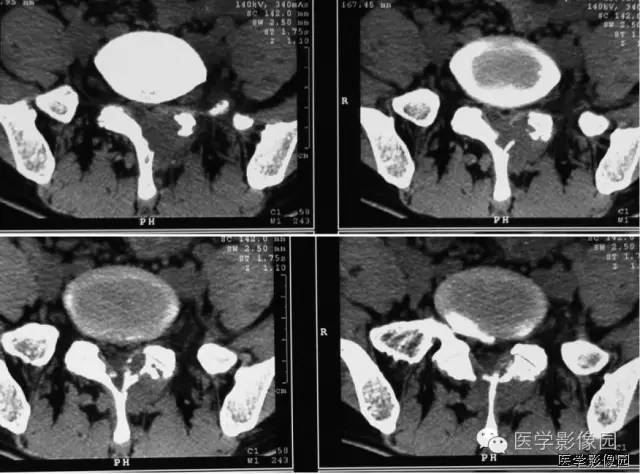 【病例】椎板骨嗜酸性肉芽肿1例CT及MR影像表现 【病例】椎板骨嗜酸性肉芽肿1例CT及MR影像表现