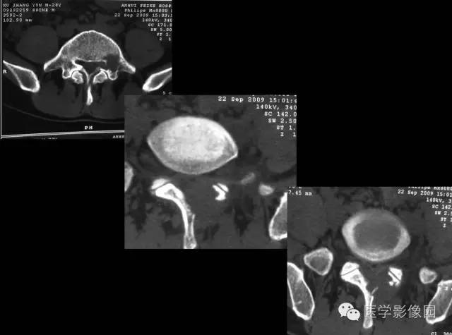 【病例】椎板骨嗜酸性肉芽肿1例CT及MR影像表现 【病例】椎板骨嗜酸性肉芽肿1例CT及MR影像表现