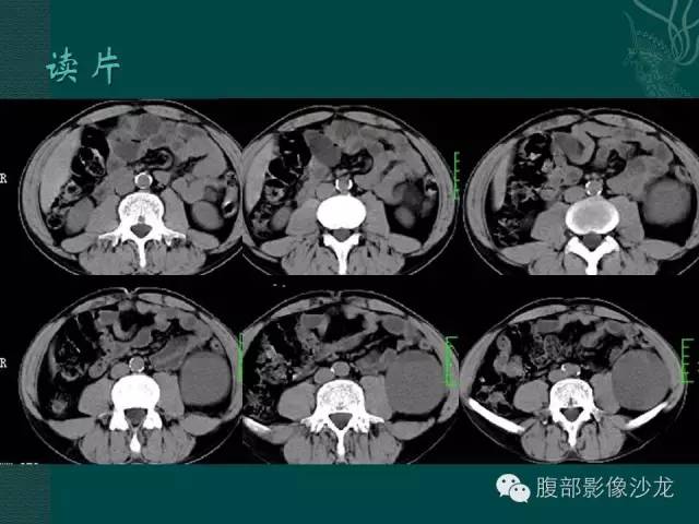 【病例】腹膜后神经鞘瘤1例CT影像表现 【病例】腹膜后神经鞘瘤1例CT影像表现