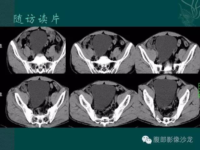 【病例】腹膜后神经鞘瘤1例CT影像表现 【病例】腹膜后神经鞘瘤1例CT影像表现