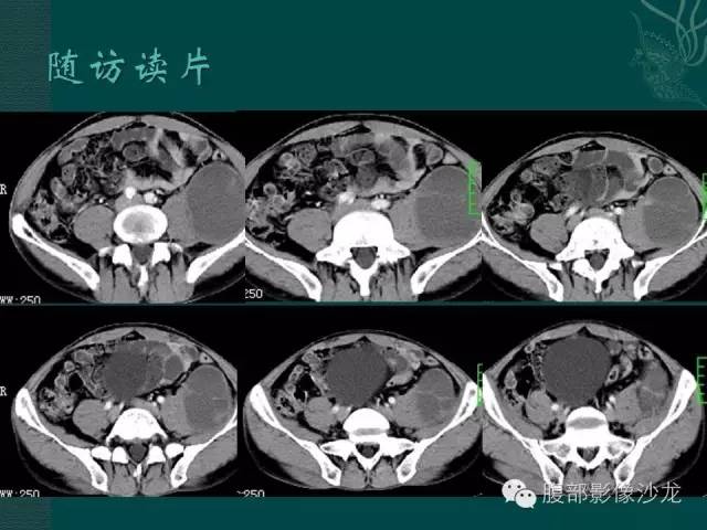 【病例】腹膜后神经鞘瘤1例CT影像表现 【病例】腹膜后神经鞘瘤1例CT影像表现