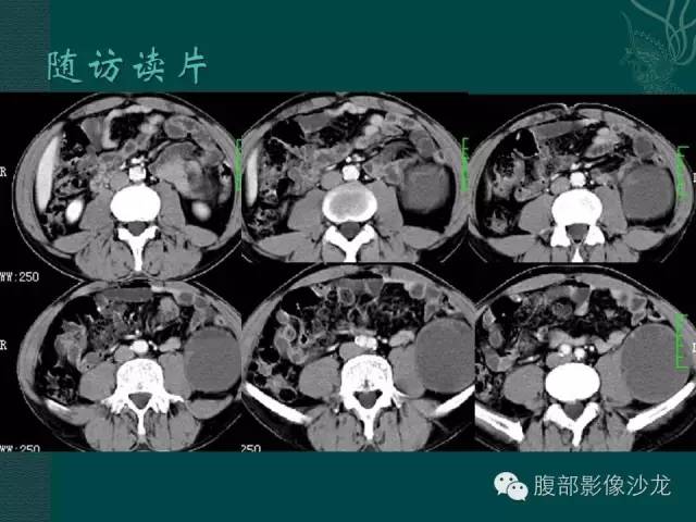 【病例】腹膜后神经鞘瘤1例CT影像表现 【病例】腹膜后神经鞘瘤1例CT影像表现