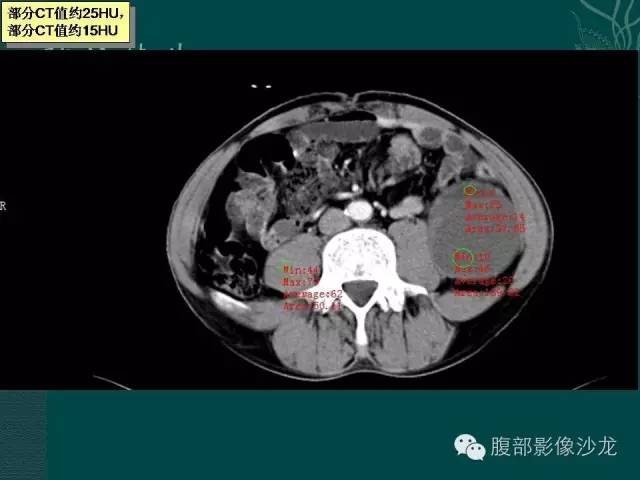 【病例】腹膜后神经鞘瘤1例CT影像表现 【病例】腹膜后神经鞘瘤1例CT影像表现