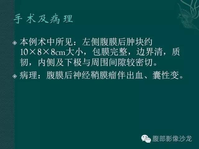【病例】腹膜后神经鞘瘤1例CT影像表现 【病例】腹膜后神经鞘瘤1例CT影像表现