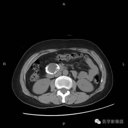 【病例】胰腺实性假乳头状瘤