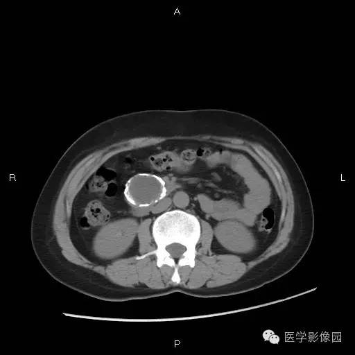 【病例】胰腺实性假乳头状瘤
