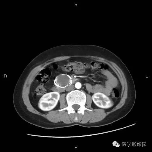 【病例】胰腺实性假乳头状瘤