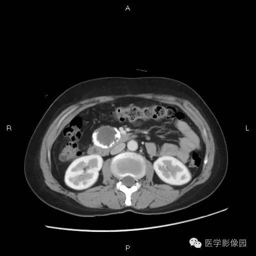 【病例】胰腺实性假乳头状瘤