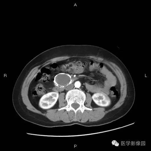【病例】胰腺实性假乳头状瘤