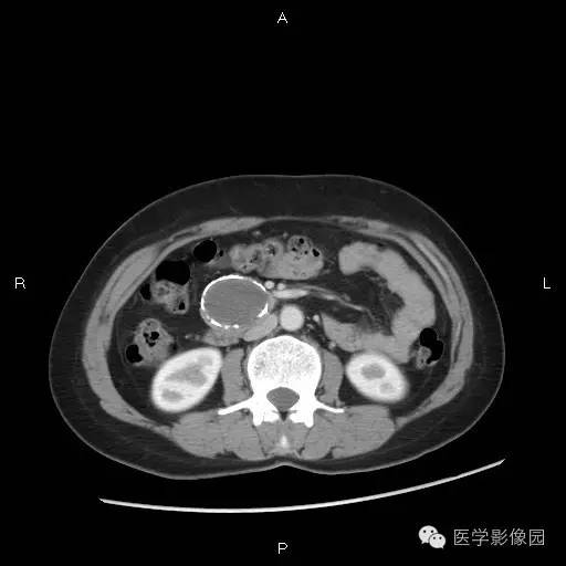 【病例】胰腺实性假乳头状瘤