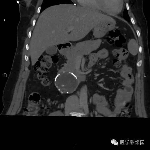 【病例】胰腺实性假乳头状瘤