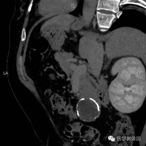【病例】胰腺实性假乳头状瘤