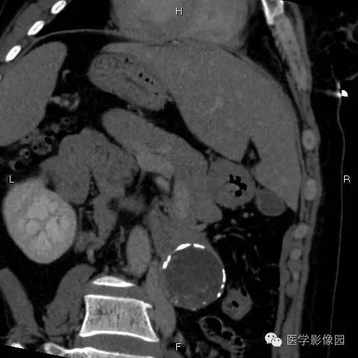 【病例】胰腺实性假乳头状瘤