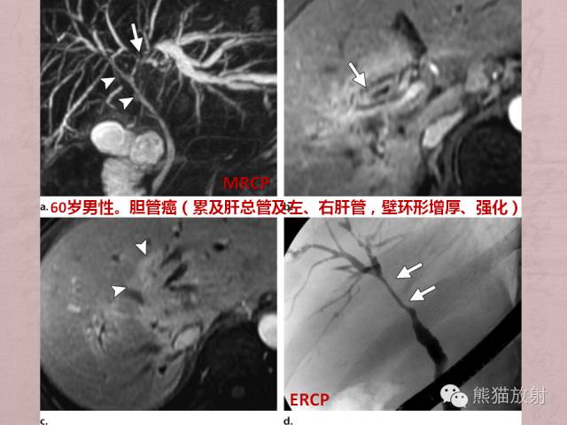 【PPT】成人胆管狭窄的MRI及MRCP表现