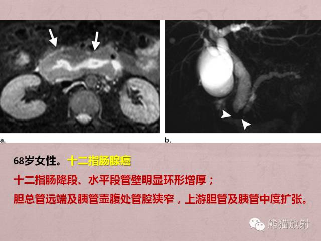 【PPT】成人胆管狭窄的MRI及MRCP表现