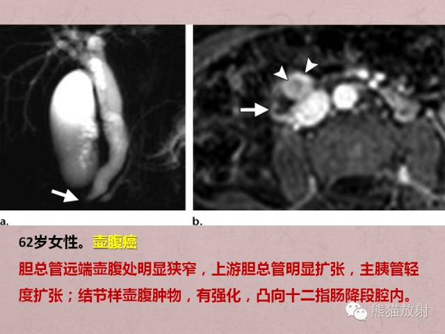 【PPT】成人胆管狭窄的MRI及MRCP表现