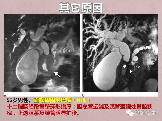【PPT】成人胆管狭窄的MRI及MRCP表现