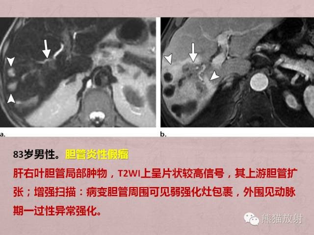 【PPT】成人胆管狭窄的MRI及MRCP表现