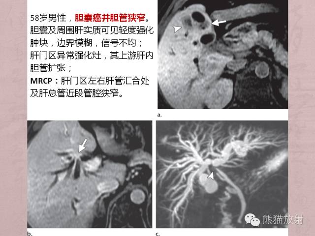 【PPT】成人胆管狭窄的MRI及MRCP表现