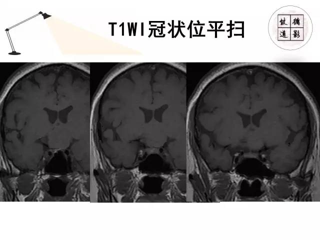 【病例】神经垂体颗粒细胞瘤1例MR影像表现