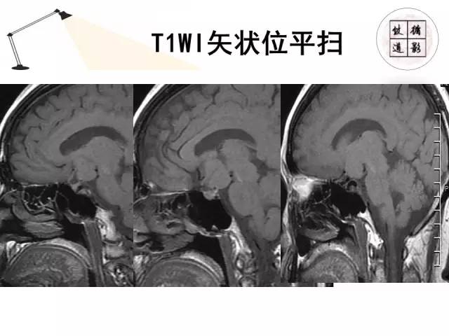 【病例】神经垂体颗粒细胞瘤1例MR影像表现