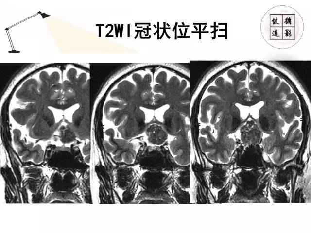 【病例】神经垂体颗粒细胞瘤1例MR影像表现