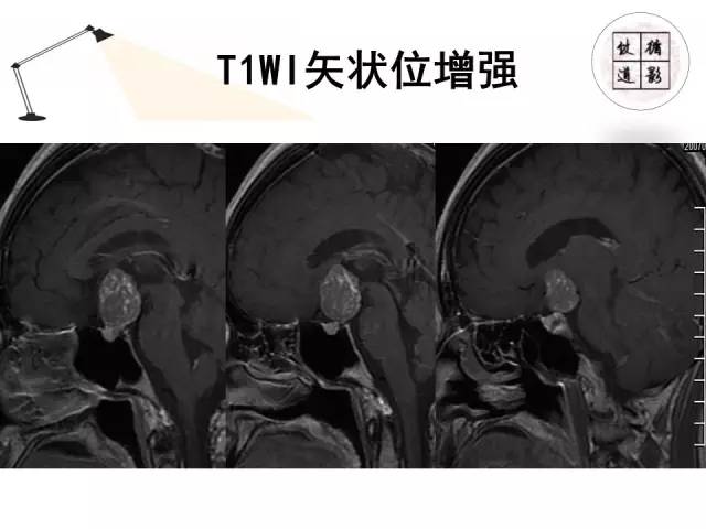 【病例】神经垂体颗粒细胞瘤1例MR影像表现