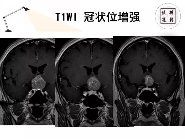 【病例】神经垂体颗粒细胞瘤1例MR影像表现