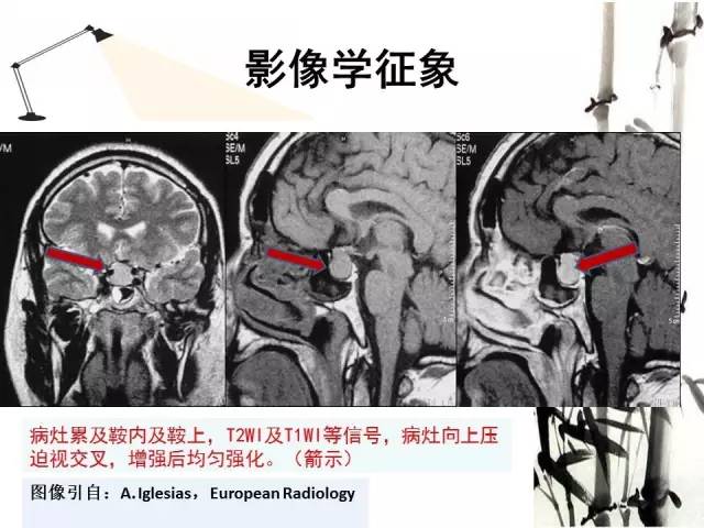 【病例】神经垂体颗粒细胞瘤1例MR影像表现