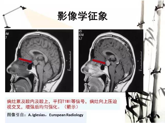 【病例】神经垂体颗粒细胞瘤1例MR影像表现