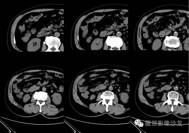 【病例】十二指肠乳头神经内分泌肿瘤1例CT影像表现